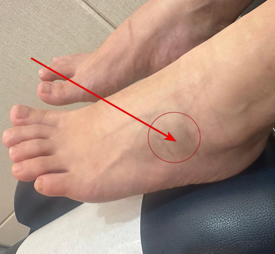 발등에 붉은 화살표와 원으로 표시된 부위가 있는 발 사진 — 서울 바로한의원 초음파 약침·도침