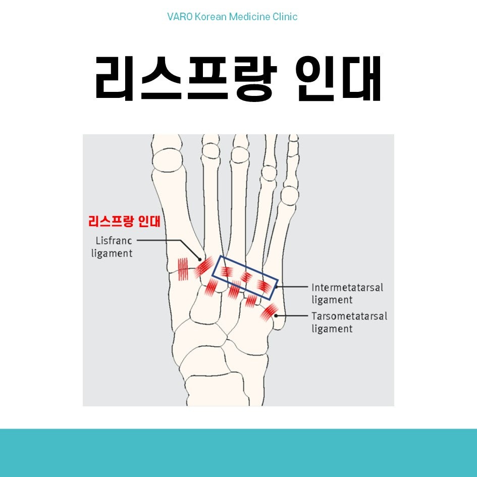 발의 리스프랑 인대와 주변 인대 위치를 보여주는 해부학적 그림입니다 — 서울 바로한의원 초음파 약침·도침