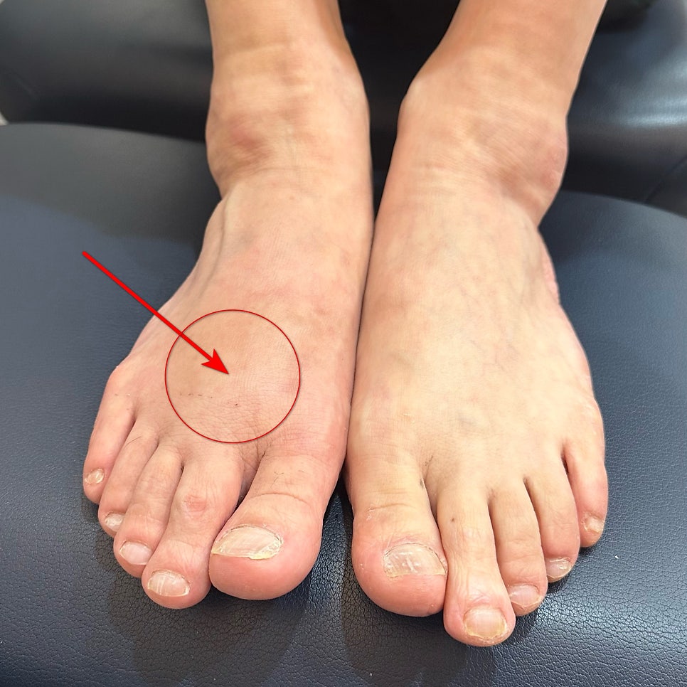 붉은 화살표와 원으로 왼쪽 발등 중족골 부위를 가리키는 발 사진 — 서울 바로한의원 초음파 약침·도침