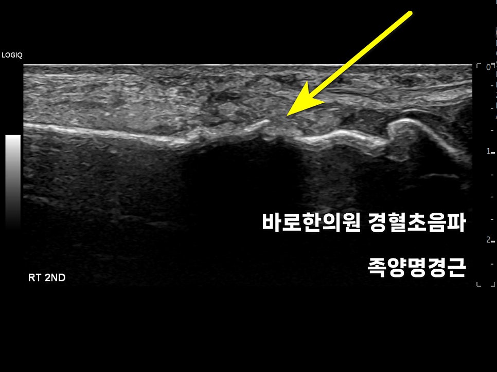 발등 중족골 부위의 초음파 영상으로, 노란색 화살표가 가리키는 부분이 보인다 — 초음파 정밀 진단 | 서울 바로한의원 초음파 약침·도침·침도