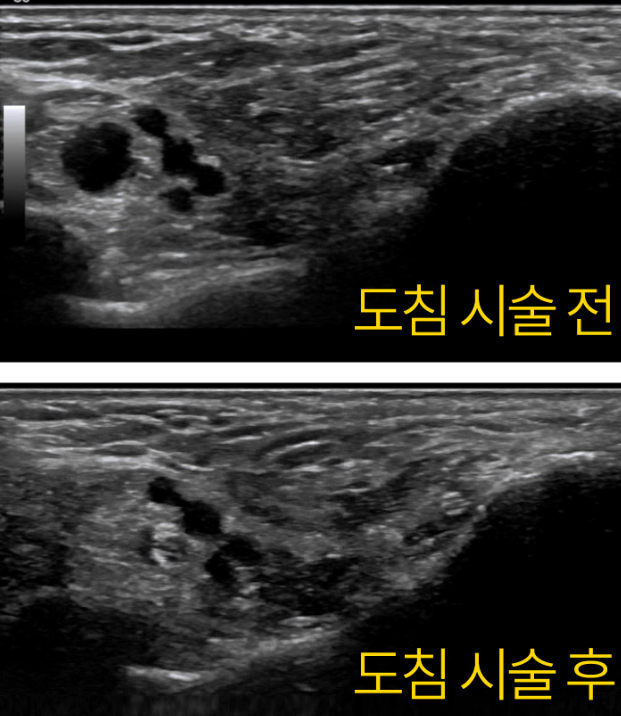 도침 시술 전후를 비교하는 발 부위 초음파 사진 — 초음파 유도하 약침 시술 | 서울 바로한의원