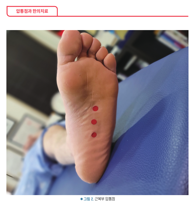 발바닥에 압통점 세 곳이 빨간 점으로 표시된 모습 — 서울 바로한의원 초음파 약침·도침
