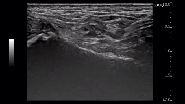 발바닥 부위의 초음파 영상 — 초음파 정밀 진단 | 서울 바로한의원 초음파 약침·도침·침도
