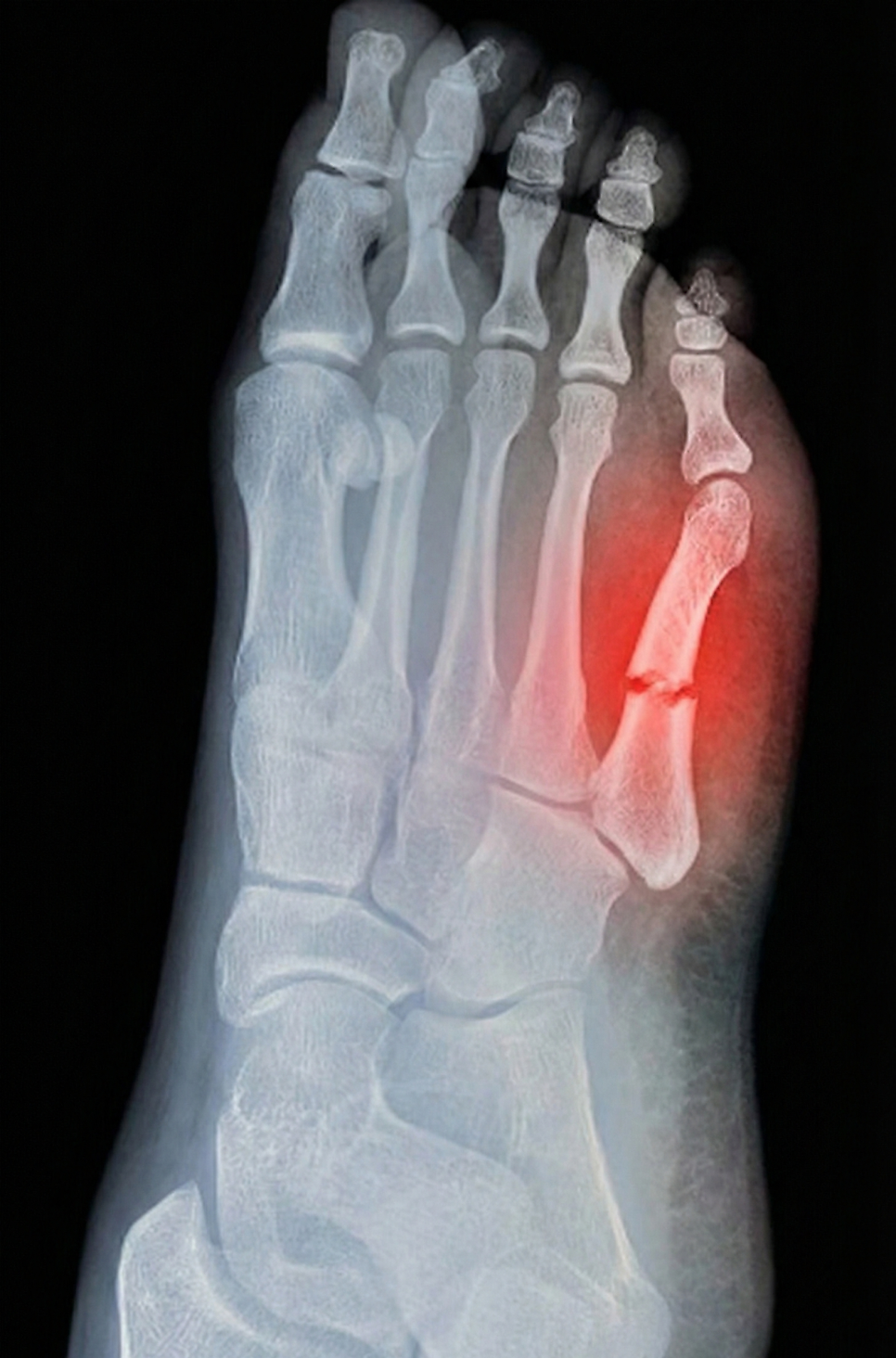 발가락 뼈가 골절된 발 X-ray 사진 — 서울 바로한의원 초음파 약침·도침