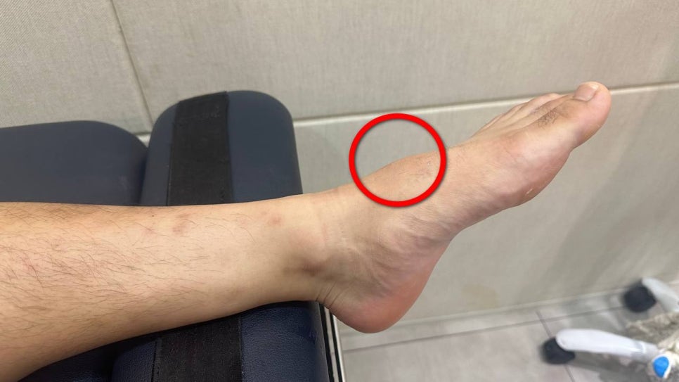 발등에 빨간 원으로 표시된 부위가 있는 발 사진 — 서울 바로한의원 초음파 약침·도침