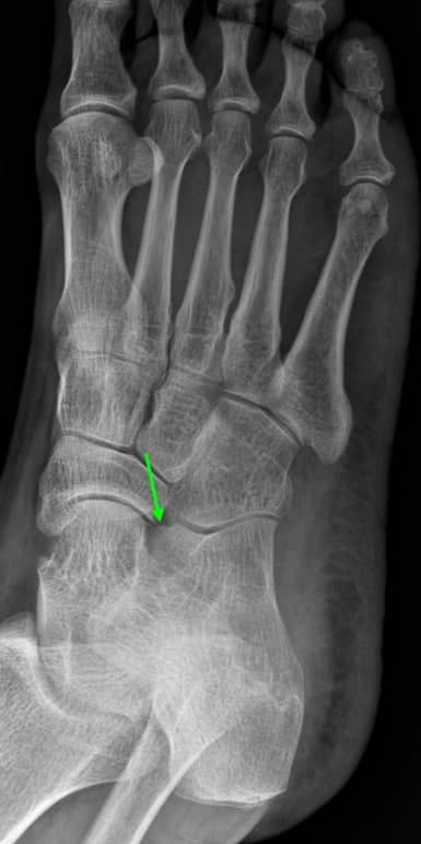 발 X-ray 사진에서 녹색 화살표가 발목 부위의 작은 뼈를 가리키고 있습니다 — 서울 바로한의원 초음파 약침·도침