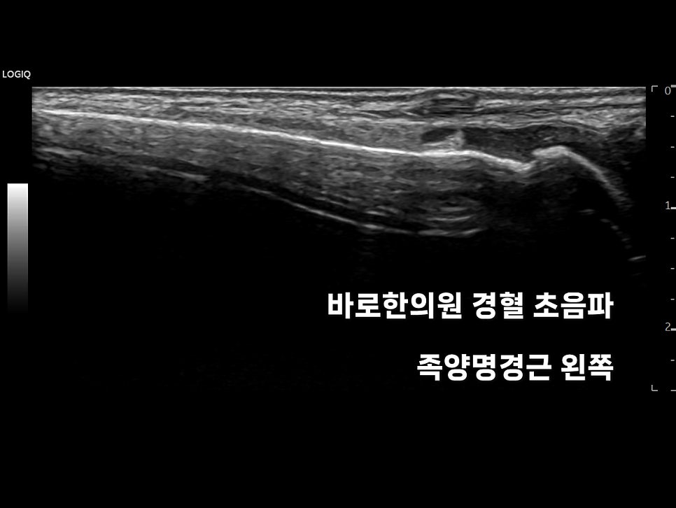 왼쪽 족양명경근 부위의 초음파 영상 — 초음파 정밀 진단 | 서울 바로한의원 초음파 약침·도침·침도