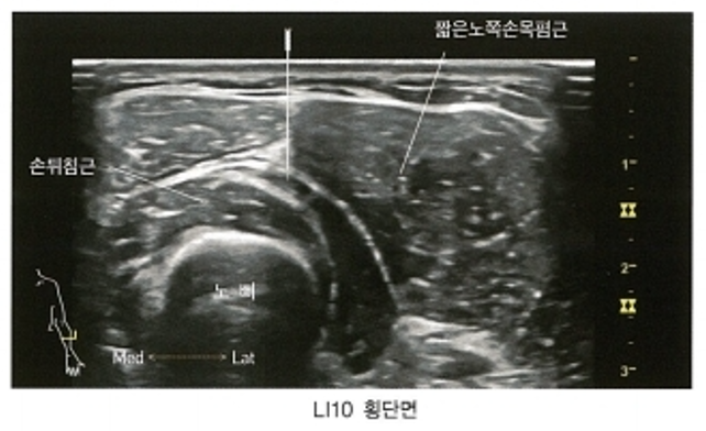 팔의 LI10 경혈 부위 초음파 이미지로, 손뒤침근과 짧은노쪽손목폄근, 노뼈가 보이며 침이 삽입되어 있다 — 초음파 정밀 진단 | 서울 바로한의원 초음파 약침·도침·침도
