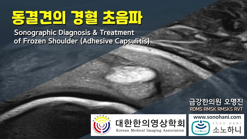 동결견의 경혈 초음파라는 제목과 함께 어깨 초음파 영상이 배경으로 보이는 이미지 — 초음파 정밀 진단 | 서울 바로한의원 초음파 약침·도침·침도