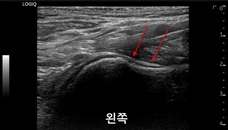 어깨 관절 초음파 사진으로, 빨간 화살표가 특정 부위를 가리키고 있으며 '왼쪽'이라는 글자가 보인다 — 초음파 정밀 진단 | 서울 바로한의원 초음파 약침·도침·침도
