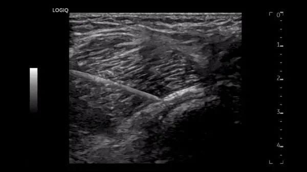 오십견 증상 진단 MRI 치료? <이것> 먼저 확인