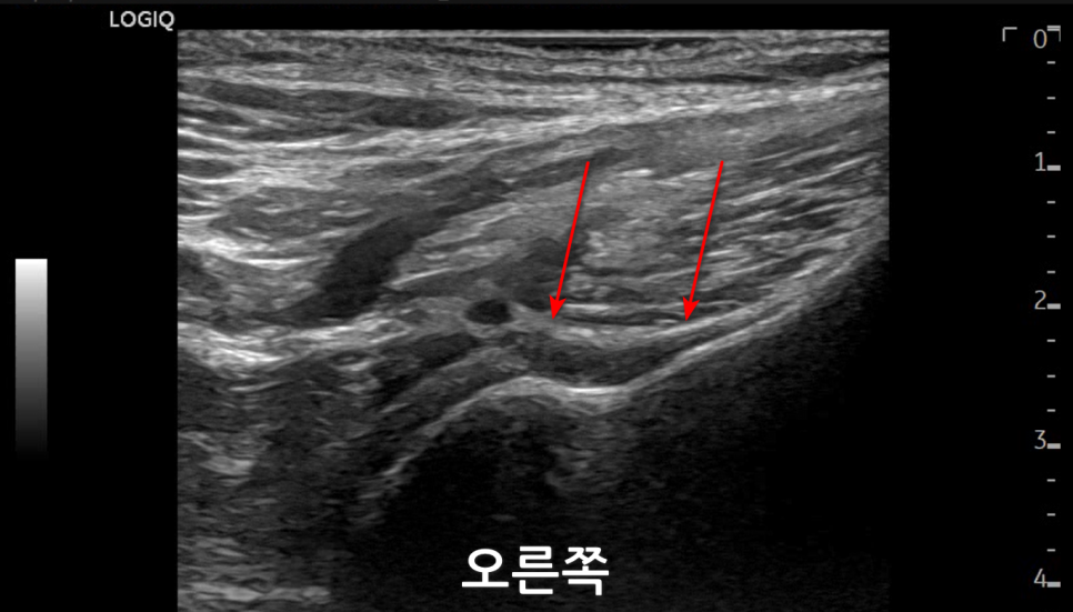 오른쪽 어깨 부위 초음파 영상에 빨간 화살표가 표시되어 있다 — 초음파 정밀 진단 | 서울 바로한의원 초음파 약침·도침·침도