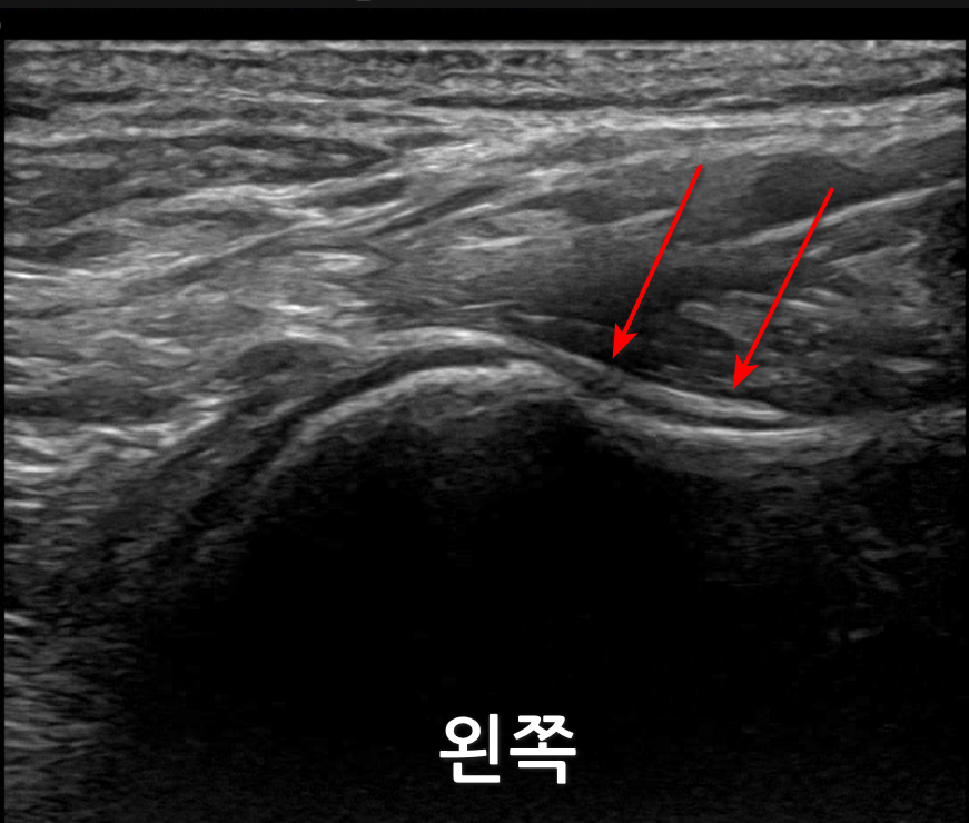 어깨 관절 초음파 사진으로, 빨간 화살표가 관절낭 부위를 가리키고 있다 — 초음파 정밀 진단 | 서울 바로한의원 초음파 약침·도침·침도
