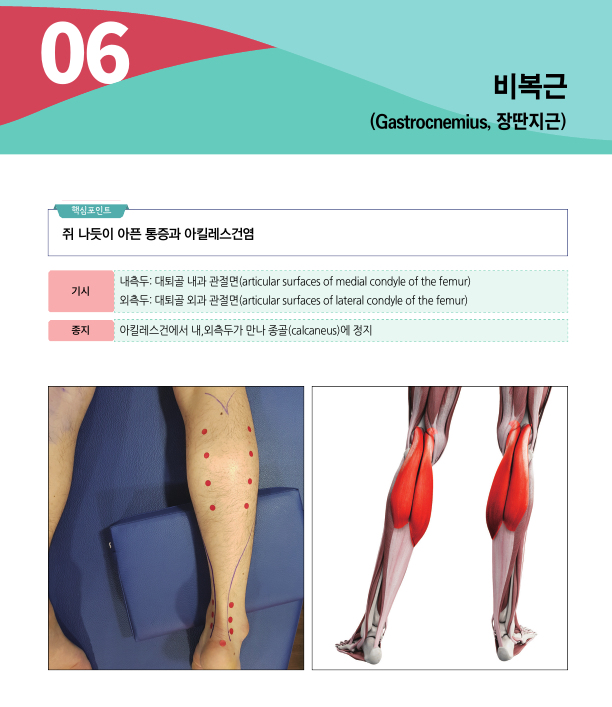 종아리 근육인 비복근의 해부학적 설명과 함께 종아리에 붉은 점으로 표시된 부위 및 비복근 해부학 그림이 있는 이미지 — 서울 바로한의원 초음파 약침·도침