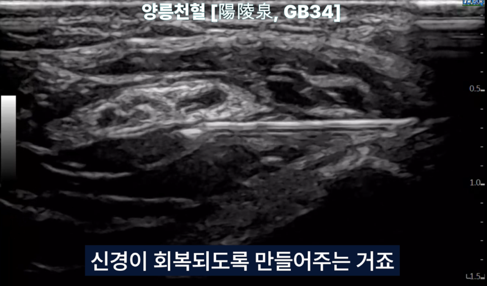 초음파 화면에서 양릉천혈(GB34) 부위에 약침 시술 중인 모습 — 초음파 유도하 약침 시술 | 서울 바로한의원