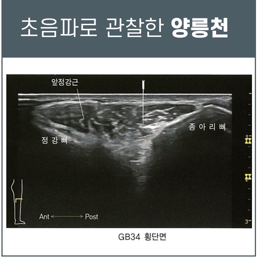 초음파로 관찰한 양릉천 혈자리 주변의 정강뼈, 종아리뼈, 앞정강근을 보여주는 이미지 — 초음파 정밀 진단 | 서울 바로한의원 초음파 약침·도침·침도