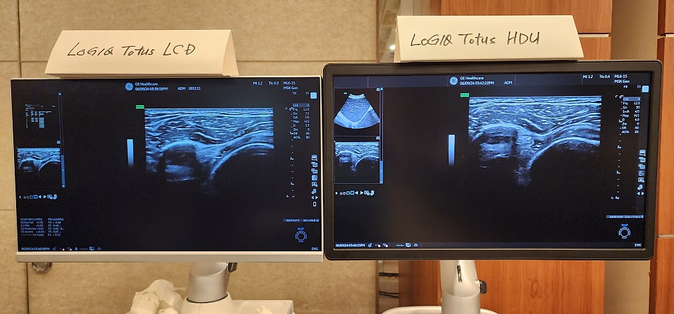 두 대의 모니터에 초음파 영상이 표시되어 있으며, 각 모니터 위에는 'Logiq Totus LCD'와 'Logiq Totus HDU'라는 이름표가 놓여 있습니다 — 초음파 정밀 진단 | 서울 바로한의원 초음파 약침·도침·침도