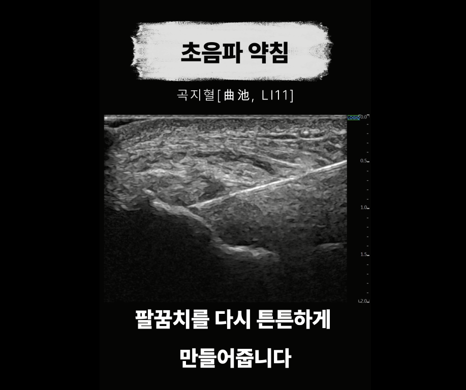 초음파 화면에 곡지혈 부위에 침이 삽입된 모습 — 초음파 정밀 진단 | 서울 바로한의원 초음파 약침·도침·침도