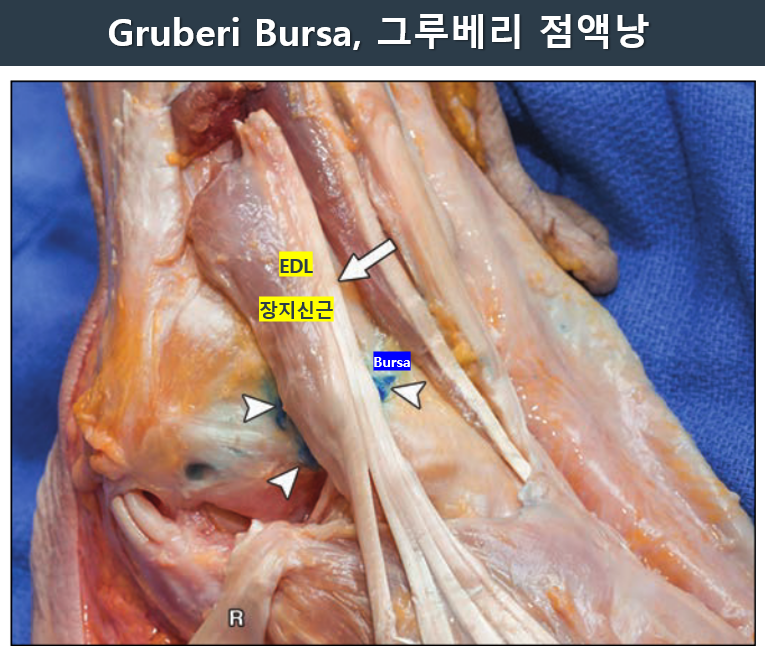 발 해부 사진에서 그루베리 점액낭과 장지신근을 표시한 모습 — 서울 바로한의원 초음파 약침·도침