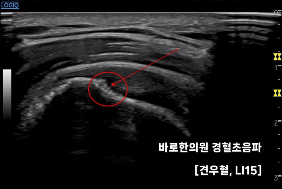 견우혈(LI15) 부위의 초음파 영상으로, 붉은 원과 화살표가 특정 부위를 가리키고 있다 — 초음파 정밀 진단 | 서울 바로한의원 초음파 약침·도침·침도
