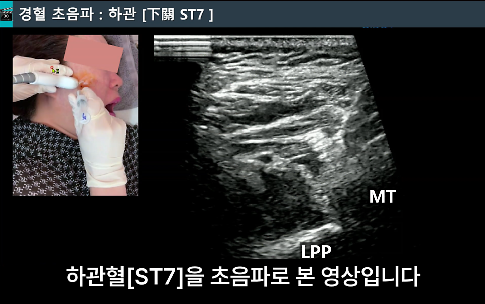 초음파 기기로 하관혈(ST7) 부위를 보며 약침 시술을 받는 사람의 모습과 해당 부위의 초음파 영상 — 초음파 유도하 약침 시술 | 서울 바로한의원