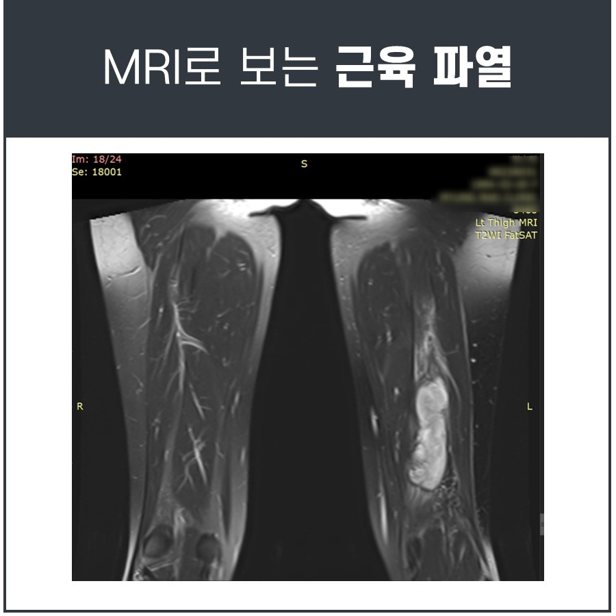 MRI로 본 왼쪽 허벅지 햄스트링 근육 파열 부위 — 서울 바로한의원 초음파 약침·도침