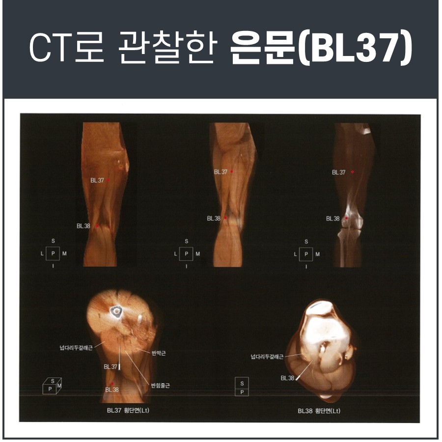 허벅지 뒤쪽의 은문(BL37)과 위양(BL38) 혈자리를 CT로 관찰한 이미지 — 서울 바로한의원 초음파 약침·도침