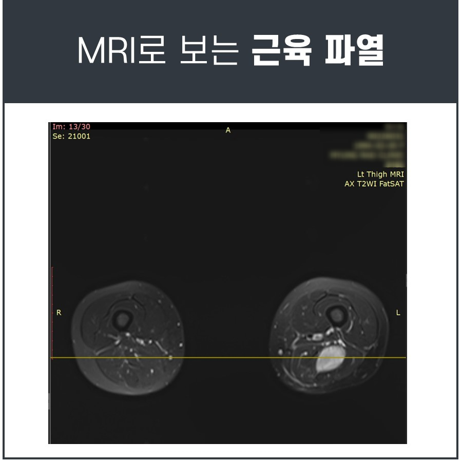 왼쪽 허벅지 근육이 파열되어 밝게 보이는 MRI 이미지 — 서울 바로한의원 초음파 약침·도침