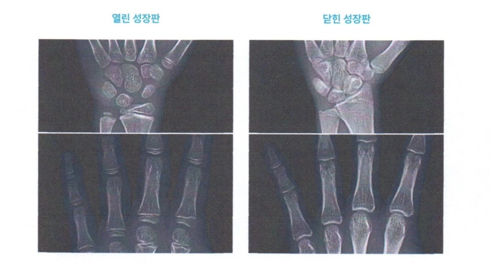 열린 성장판과 닫힌 성장판을 보여주는 두 개의 손 엑스레이 사진 — 서울 바로한의원 초음파 약침·도침