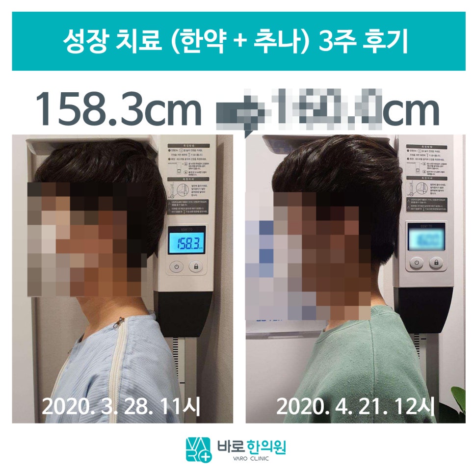 한의원에서 키 성장 치료 전후를 비교한 사진으로, 왼쪽은 158.3cm, 오른쪽은 160.0cm로 측정된 모습입니다 — 서울 바로한의원 초음파 약침·도침