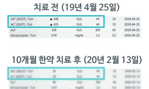 한약 치료 전후의 간 수치(AST, ALT) 검사 결과표 — 서울 바로한의원 초음파 약침·도침