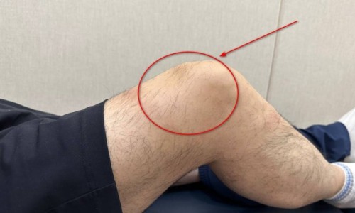 옆에서 본 무릎에 빨간 원과 화살표로 표시된 모습 — 서울 바로한의원 초음파 약침·도침