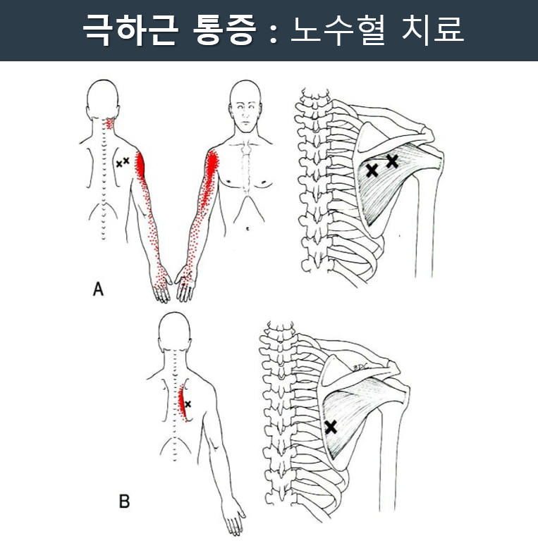 극하근 통증 유발점과 방사통을 나타내는 인체 해부도 — 서울 바로한의원 초음파 약침·도침