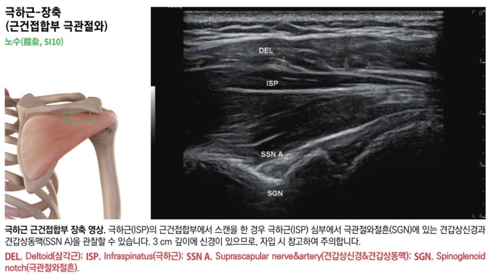 어깨 해부학 그림과 극하근 건근접합부의 초음파 영상. 삼각근, 극하근, 견갑상신경 및 동맥, 극관절와절흔이 표시되어 있다 — 초음파 정밀 진단 | 서울 바로한의원 초음파 약침·도침·침도