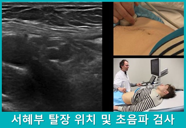 서혜부 탈장 초음파 영상과 환자에게 초음파 검사를 하는 의료진의 모습 — 초음파 정밀 진단 | 서울 바로한의원 초음파 약침·도침·침도