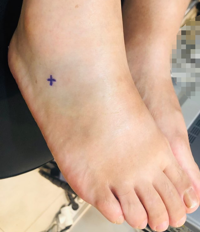 보라색 십자 표시가 있는 부어오른 발등과 발목 부위 — 서울 바로한의원 초음파 약침·도침