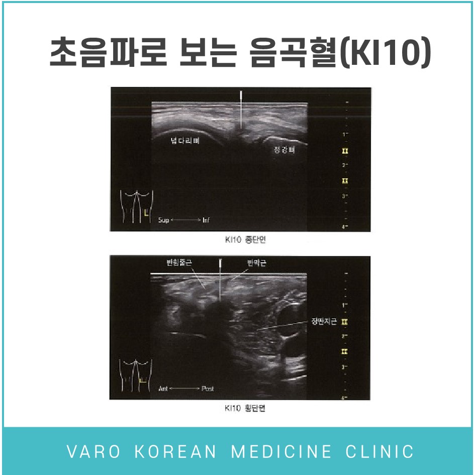 음곡혈(KI10)의 종단면과 횡단면을 보여주는 무릎 초음파 사진 — 초음파 정밀 진단 | 서울 바로한의원 초음파 약침·도침·침도
