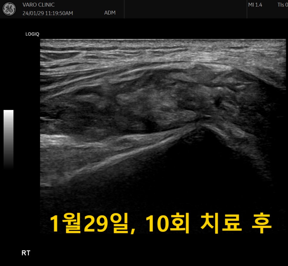 10회 치료 후 무릎 관절 부위를 촬영한 초음파 사진 — 초음파 정밀 진단 | 서울 바로한의원 초음파 약침·도침·침도