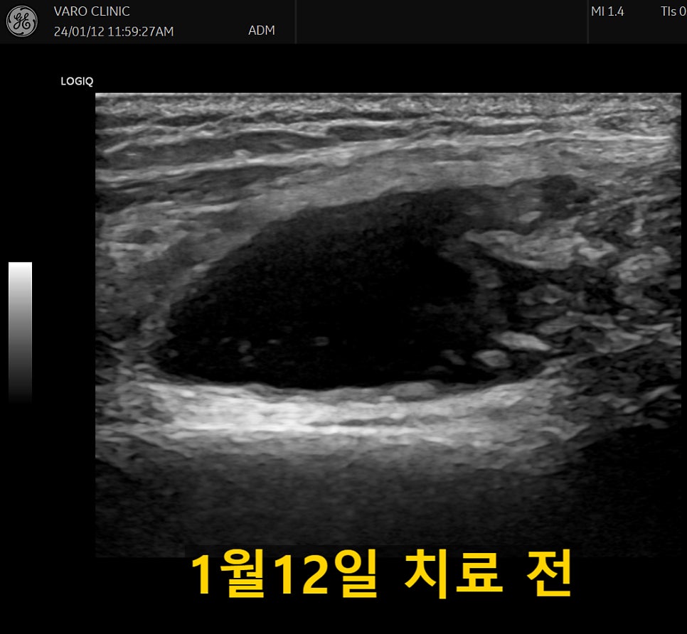 무릎에 물이 찬 상태를 보여주는 초음파 사진. 1월 12일 치료 전 — 초음파 정밀 진단 | 서울 바로한의원 초음파 약침·도침·침도