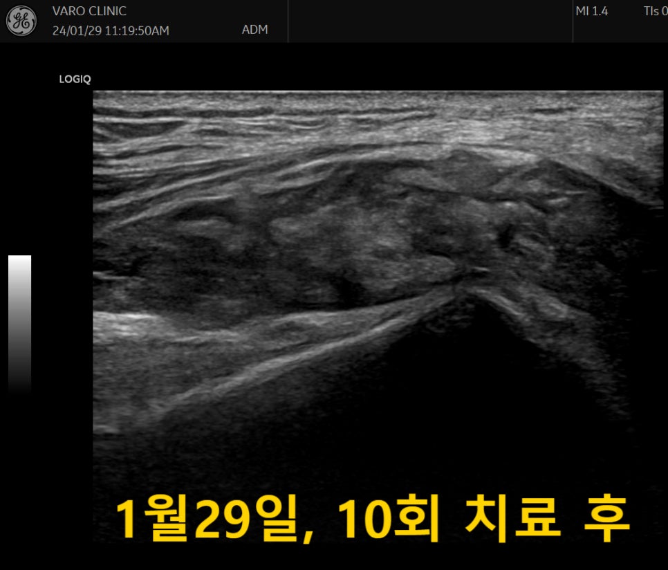 무릎 부위의 초음파 사진으로, 10회 치료 후의 모습을 나타냅니다 — 초음파 정밀 진단 | 서울 바로한의원 초음파 약침·도침·침도