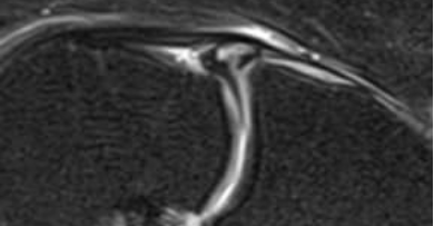 무릎 관절의 MRI 영상 — 서울 바로한의원 초음파 약침·도침