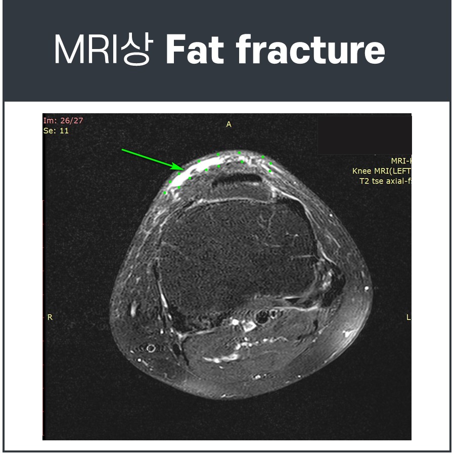 무릎 MRI 영상에서 슬개골 주변의 지방 골절을 가리키는 화살표 — 서울 바로한의원 초음파 약침·도침