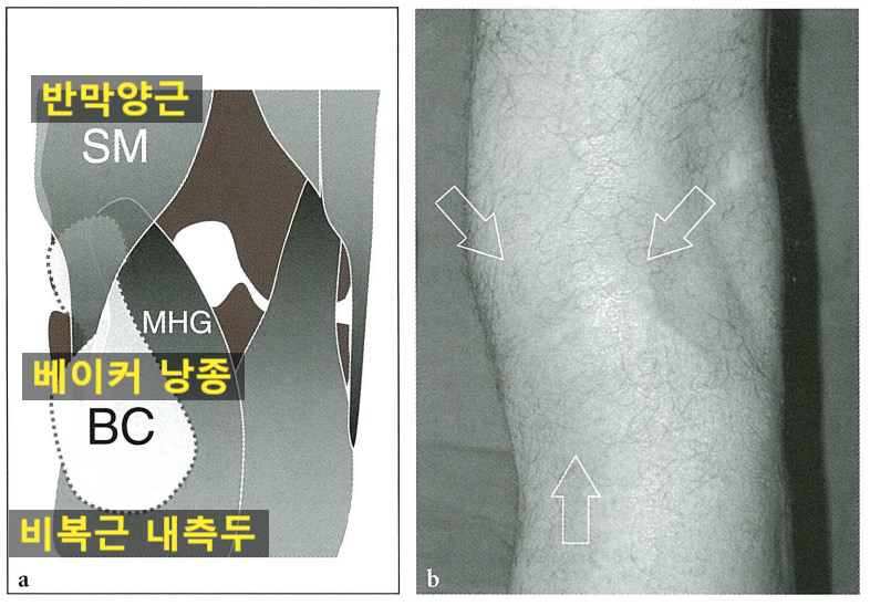 무릎 오금 부위의 베이커 낭종 위치를 보여주는 해부학적 그림과 실제 무릎 오금 부위에 혹이 생긴 사진 — 서울 바로한의원 초음파 약침·도침