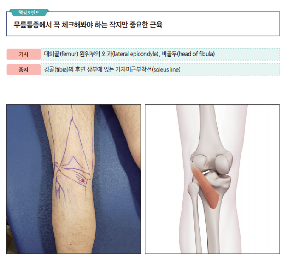 무릎 뒤쪽 슬와근의 해부학적 위치와 통증점을 표시한 다리 사진과 슬와근 해부도 — 서울 바로한의원 초음파 약침·도침