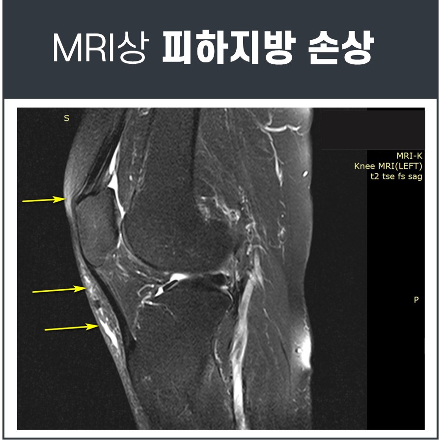 왼쪽 무릎 MRI 영상에서 피하지방 손상 부위를 노란색 화살표로 표시한 모습 — 서울 바로한의원 초음파 약침·도침