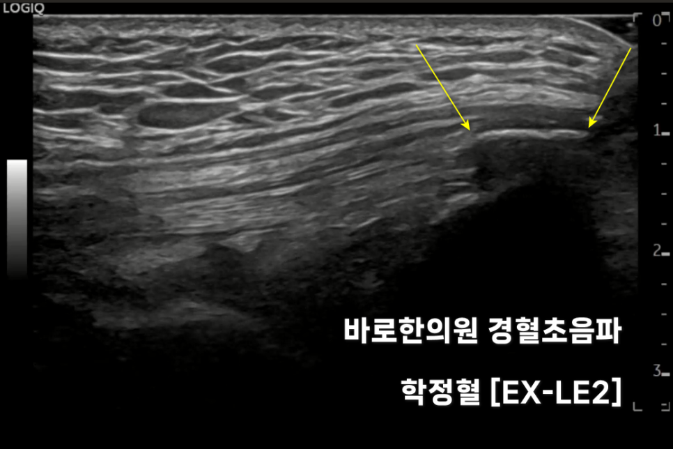 무릎 힘줄에 석회화가 보이는 초음파 사진 — 초음파 정밀 진단 | 서울 바로한의원 초음파 약침·도침·침도