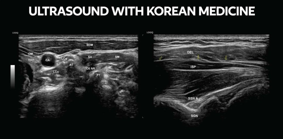 인체 해부학적 구조가 표시된 두 개의 흑백 초음파 이미지 — 초음파 정밀 진단 | 서울 바로한의원 초음파 약침·도침·침도
