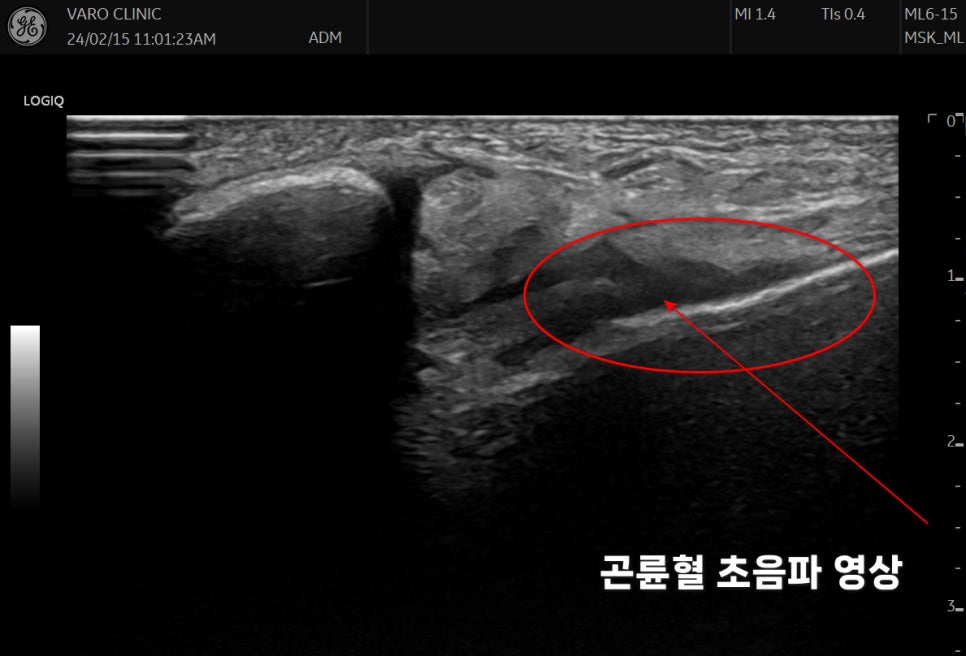 초음파 영상에서 곤륜혈 부위에 침이 삽입된 모습 — 초음파 유도하 약침 시술 | 서울 바로한의원