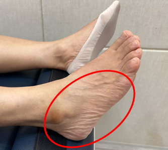 빨간색 원으로 표시된 발의 바깥쪽 복숭아뼈와 발 옆면 — 서울 바로한의원 초음파 약침·도침