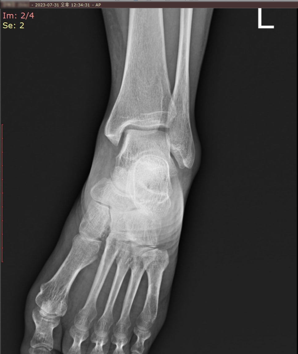 왼쪽 발과 발목의 사선 X-ray 사진 — 서울 바로한의원 초음파 약침·도침
